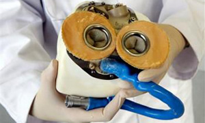 İleri derecede kalp yetmezliği olan hasta yapay kalple hayata döndü